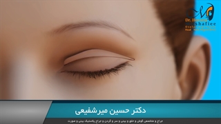 درمان تورم و افتادپی ابرو