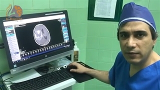 جراحی عود تومور مغزی بدخیم در آقای 64 ساله