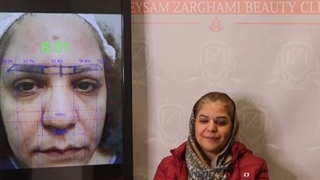 رضایت از کاشت ابرو در تهران در کلینیک ترانسپلنت