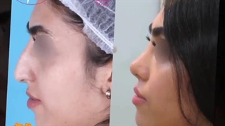 رینوپلاستی بینی استخوانی