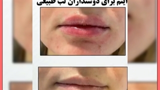عوارض احتمالی تزریق ژل در نواحی مختلف صورت و بدن لیزر مو