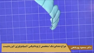 لمینت سرامیکی | کلینیک دندانپزشکی دکتر پورشاهی