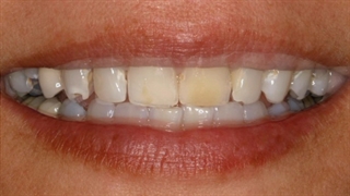 زیبایی بیشتر با اصلاح طرح لبخند | کلینیک سیمادنت