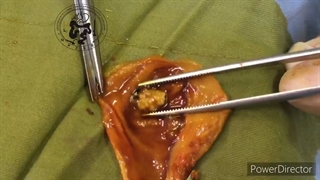 پولیپ های کیسه صفرا