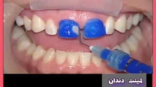 آیا لمینت دندان را خراب میکند
