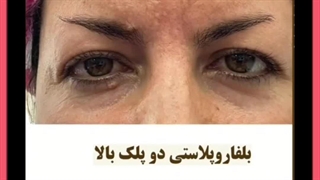 افتادگی پلک در سن کم