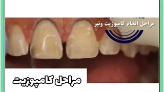 درباره ی کامپوزیت دندان