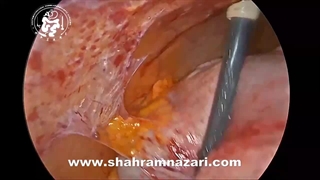 Choledochoduodenostomy after failed ERCP in a case of previous open cholecystectomy