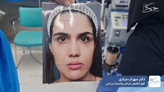 لیفت اندوسکوپی ابرو و تراش استخوان