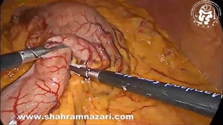 لاپاروسکوپی تومور معده