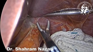 درمان آشالازی با لاپاروسکوپ