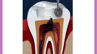 عصب کشی دندان