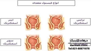 فیستول مقعد چیست و آیا خطرناک است - درمان کلینیک