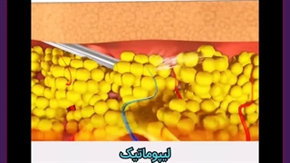 آیا عمل لیپوماتیک ضرر دارد