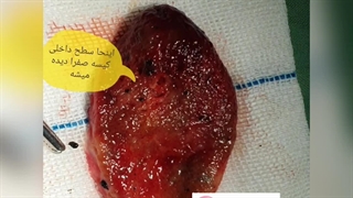 داخل کیسه ی صفرا چه شکلیه؟