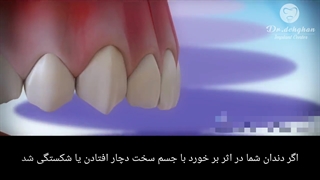 دکتر وحید دهقان : با شکستگی دندان چه کنیم؟