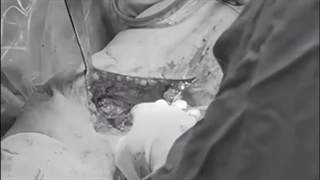 عمل جراحی اصلاح انحراف زانو در بیمار با پاهای ضربدری (ژنو والگوم)