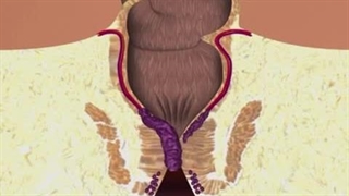 فیلم عمل جراحی بواسیر به روش سنتی و لیزر