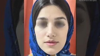 6 ماه بعد از عمل بینی طبیعی