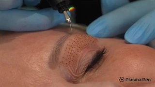 رفع افتادگی پلک