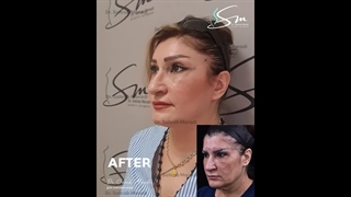 شد الوجه بالکامل