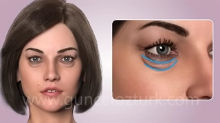 عمل بلفاروپلاستی یا رفع افتادگی پلک