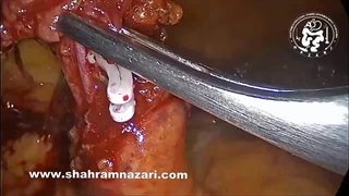 کولکتومی راست برای تومور بدخیم سکوم