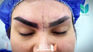 قبل و بعد کاشت ابرو توی کلینیک لاله