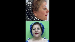عملیة شد الوجه الکامل وتجمیل الأنف