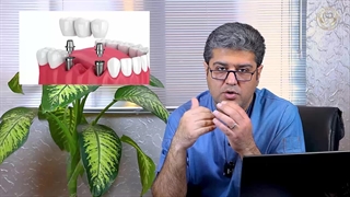 نکاتی درباره پروتز ایمپلنت