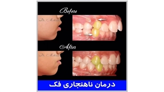 بستن فاصله دندان ها
