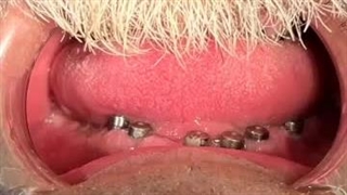 نمونه کار ایمپلنت دکتر احمدی زاده فک بالا و پایین