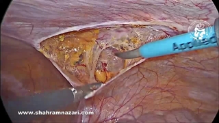 ترمیم فتق اینگوینال پیش صفاقی در زنان