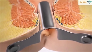 فیلم عمل شقاق با لیزر