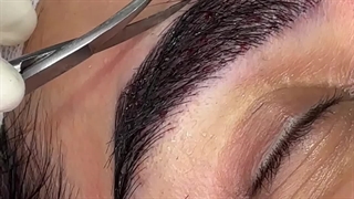 کوتاهی ابرو بعد کاشت