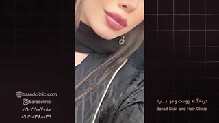 فیلر لب نچرال