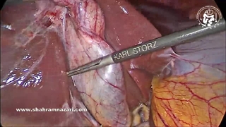 کوله‌سیستکتومی لاپاراسکوپیک ایمن