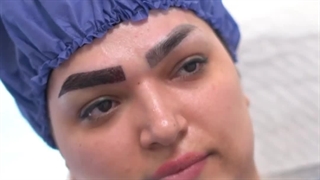 کاشت ابروی سوپر نچرال در کلینیک زیبایی رنسانس