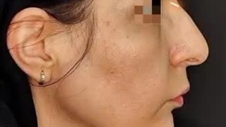 بلافاصله پس از جراحی بینی عقابی